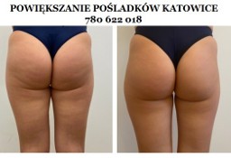 Powiększanie i Modelowanie Pośladków Katowice - Kwas L-Polimlekowy
