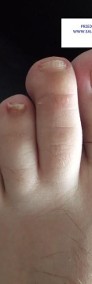 Pedicure - Kostka Arkady - Wrastające paznokcie - Pedicure leczniczy-3