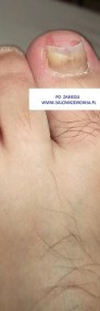 Pedicure - Kostka Arkady - Wrastające paznokcie - Pedicure leczniczy-4